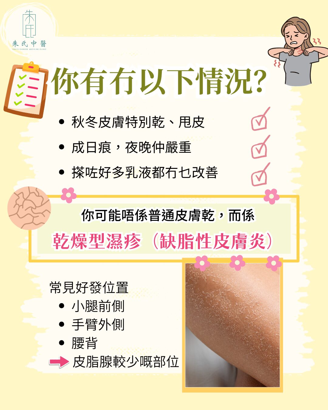 乾燥型濕疹主要特徵