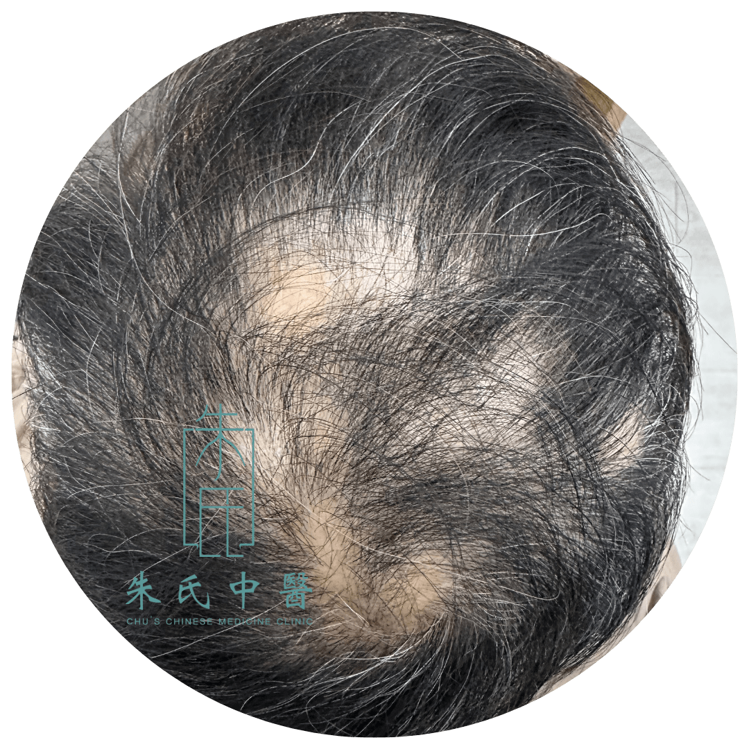 階段 1