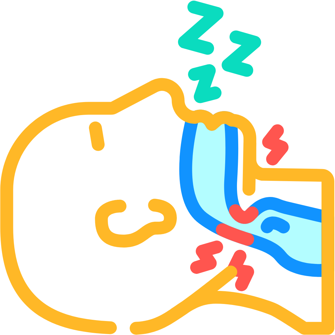睡眠窒息症成因示意圖