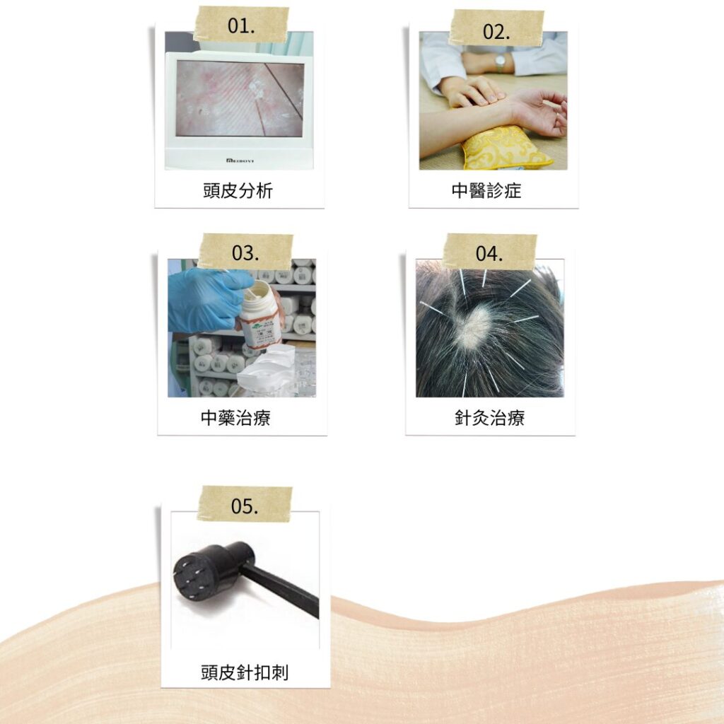 中醫治療鬼剃頭5個步驟