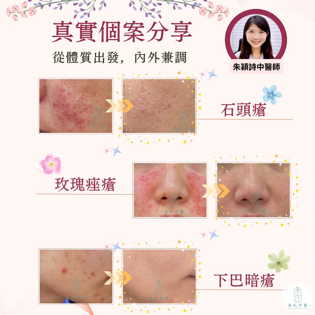 中醫美顏針個案分享