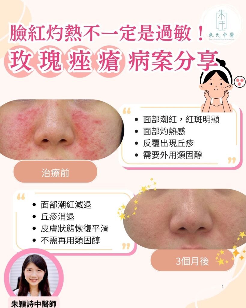 玫瑰痤瘡病案分享