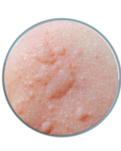 慢性蕁麻疹的典型症狀