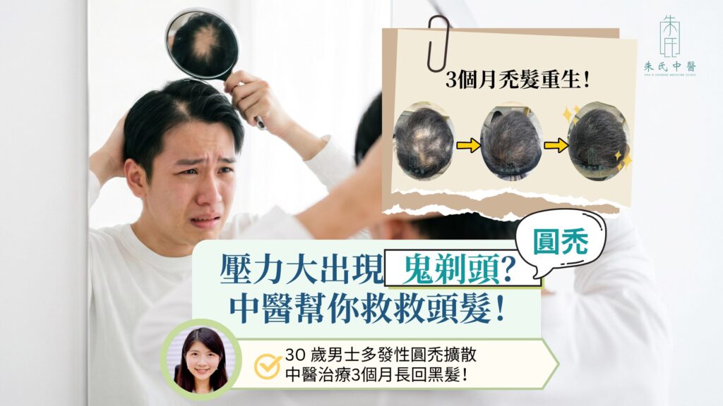 鬼剃頭 (圓禿)
