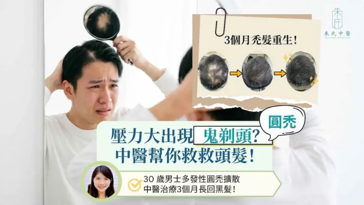 壓力大甩頭髮? 中醫針灸中藥治療鬼剃頭助生髮