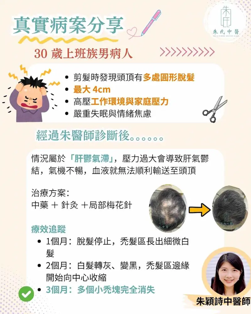 鬼剃頭案例分享對比圖